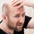 Understanding Genetics and Hereditary Hair Loss