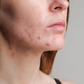 Managing Acne and Breakouts: Your Complete Guide to Clearer Skin