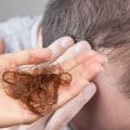 Understanding Medical Conditions That Can Cause Hair Loss