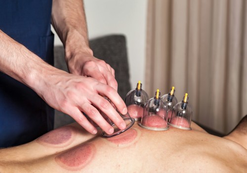 Cupping Therapy: A Holistic Approach to Wellness