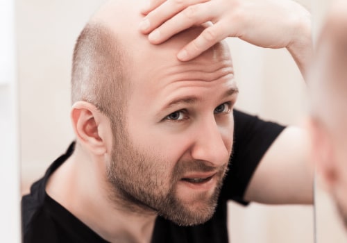 Understanding Genetics and Hereditary Hair Loss