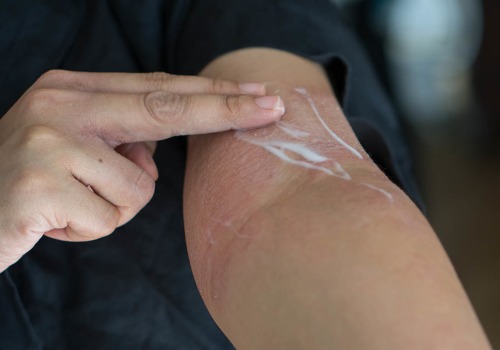 How to Effectively Treat Eczema and Other Skin Conditions