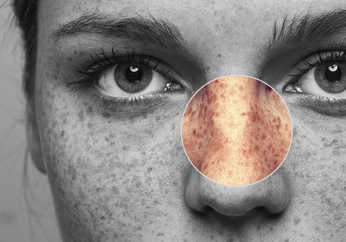 Addressing Hyperpigmentation and Dark Spots: A Comprehensive Guide to Achieving Healthier Skin