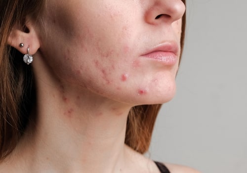 Managing Acne and Breakouts: Your Complete Guide to Clearer Skin